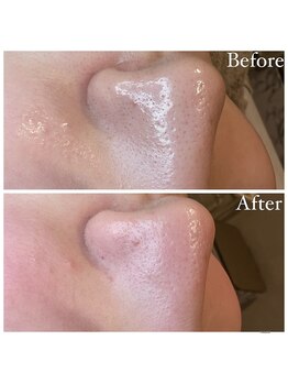 マドモアゼル 麻布十番/毛穴洗浄