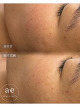 アエ(ae)/ダクトピール