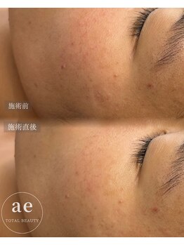 アエ(ae)/ダクトピール