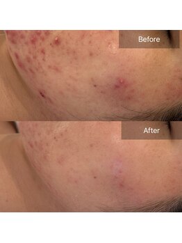 マインエム(mine.m)/顔、顎ニキビ/肌質改善