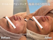 クリーンアンドビューティ 札幌(Clean&Beauty)/札幌リベルハーブピーリング♪