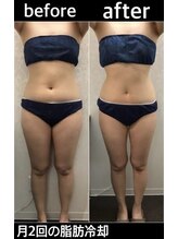 メルディアナ(MAR DIANA)/ダイヤモンドアイス脂肪冷却痩身