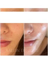 サロンドジョリー/結果が出るハーブピーリング