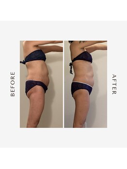 ラグレ(LUXRE)/脂肪冷却モニター（40代）