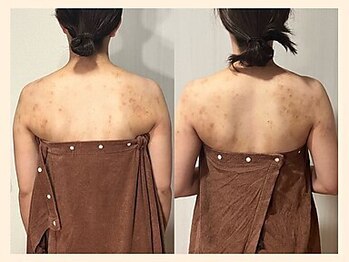 ラフリー 四条烏丸院(RUFFREE)/筋膜リリースですっきり背中に