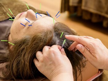 ケイ美容鍼灸整体院(KEI美容鍼灸整体院)の写真/【小顔矯正/肌質改善】顔筋ストレッチ込“その場しのぎではない”ハリウッド式美容鍼!エイジングケア効果◎