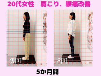 さく整骨院 新松戸店/20代会社員、巻肩、猫背改善♪