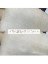 カルディエ(Cardie)/背中脱毛　ビフォーアフター