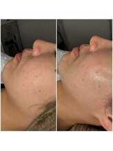 レイ(Rey)/もみあげ、スッキリ！