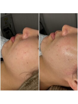 レイ(Rey)/もみあげ、スッキリ！