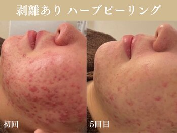 ミソル(misolle.)/症例