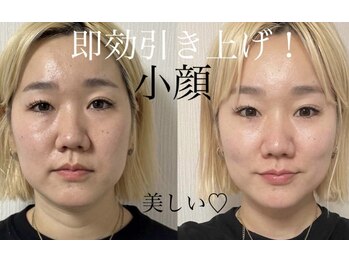 エクレクティック(ECLECTIC)/小顔/たるみケアの最強マシン