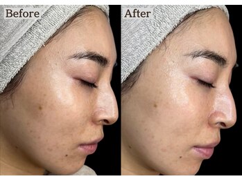 あすはれ/ハリ艶白さに肌管理ララピール