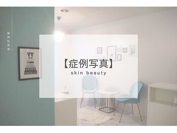 ベル 札幌(Belle)/ハーブピーリング｜Before After