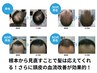男性の方～育毛促進～幹細胞エクソソームトリートメント初回お試し9,800円