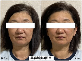 中立売鍼灸整骨院/リフトアップエイジングケア鍼灸