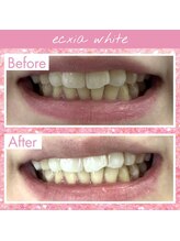 エクシアホワイトフジ(ecxia white fuji)/ホワイトニングビフォーアフター