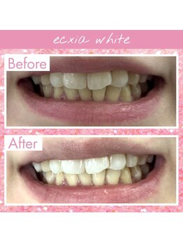 エクシアホワイトフジ(ecxia white fuji)/ホワイトニングビフォーアフター
