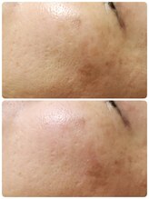 ルノア(Lunoa.)/ハーブピーリングビフォーアフタ