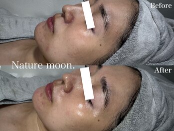 ナチュールムーン(Nature moon.)/ハーブピーリング