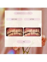 プラスビー 3号店(+b)/ホワイトニングビフォーアフター