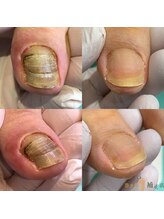 巻き爪補正店 越谷店/変形爪補正