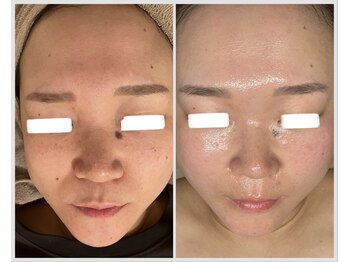 美しぐれ 溝の口/【1年】プラズマ/ピーリング/LDM