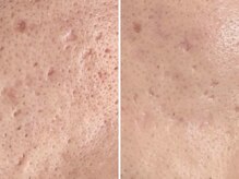 アトワ(A toi)の雰囲気（プラズマ毛穴ケア5回　深い毛穴も肌の土壌を改良で滑らかに。）