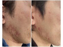 サロンドエルサ(Salon de ELSA)の雰囲気（ずっと残っているニキビアトもご相談ください◎）