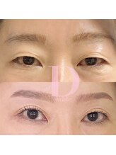 デルタヌー(deltanuu)/一重奥二重にお悩みの方はこちら