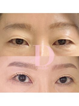 デルタヌー(deltanuu)/一重奥二重にお悩みの方はこちら