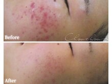 シュシュ(Chou chou)/【Before★After】ニキビ改善