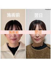 リフェイスフサエ(ReFace Fusae)/お顔の変化