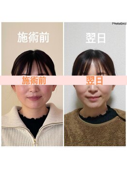 リフェイスフサエ(ReFace Fusae)/お顔の変化