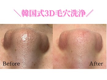 ダイヤモンド リーエンダ(Diamond leende)/韓国式3D毛穴洗浄