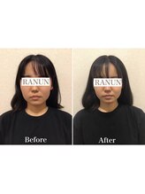 池袋東口整体院/ハイパーナイフ×小顔矯正