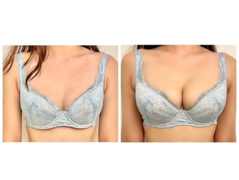 美人バスト 町田店/バストアップ◇症例◇