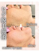 フィズ 海老名店(FIS)/ヒゲ脱毛