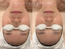 ヒビキノ バイ ヒビハンビューティー(hibikino by Hibihan Beauty)の雰囲気(光フェイシャルはお悩みに合わせて特化した施術も可能です♪)