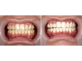 ルミナ(LUMINA)/男性もホワイトニング!