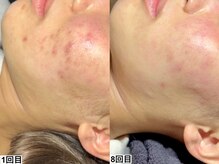 アンドミー 名駅(&me)/お肌の外側・内側から徹底ケア◎