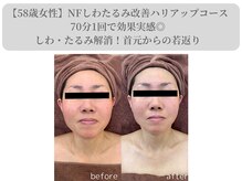 エターナルフレーム(Eternal Flame)/58歳NFビフォーアフター