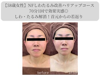 エターナルフレーム(Eternal Flame)/58歳NFビフォーアフター