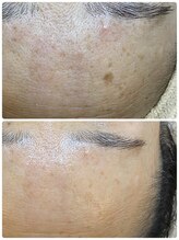 サロンドフルール/「ADS」プログラム＋シミケア3回