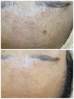 サロンドフルール/「ADS」プログラム＋シミケア3回