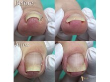 巻き爪補正店 池袋店の雰囲気（こんな巻き爪のお悩みも解決☆生活しやすい足にしましょう♪）