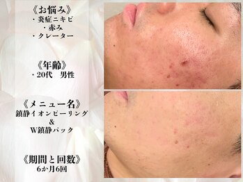 アクール(Accueil)/【ニキビ・跡】