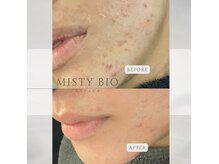 ゆらぎを受け入れながら肌ケア◎コース継続のお客様6ヶ月のお肌