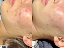 和歌山ララピール&韓国肌管理専門店/ハーブピーリング【肌質改善】