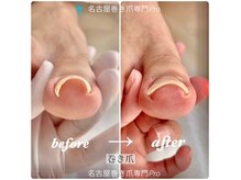 名古屋巻き爪専門 Pro